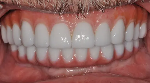 Case 1, after treatment at Ponte Vedra Family Dentistry.