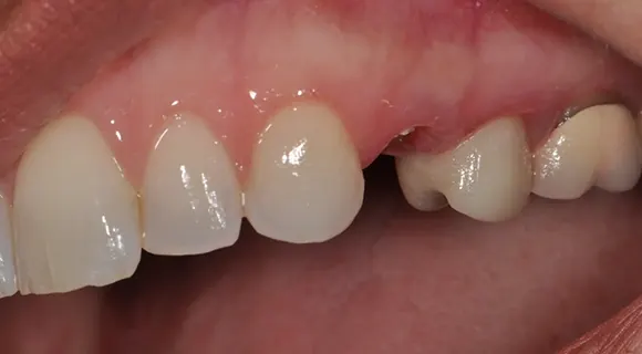 Case 2, before: a damaged upper row with a missing tooth.
