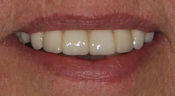 Case 3, after treatment at Ponte Vedra Family Dentistry.