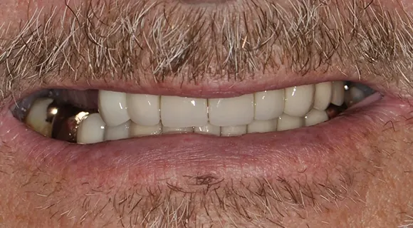 Case 4, before: yellowed teeth.