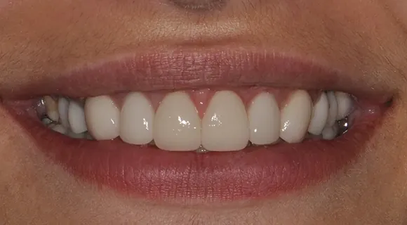 Case 5, after treatment at Ponte Vedra Family Dentistry.